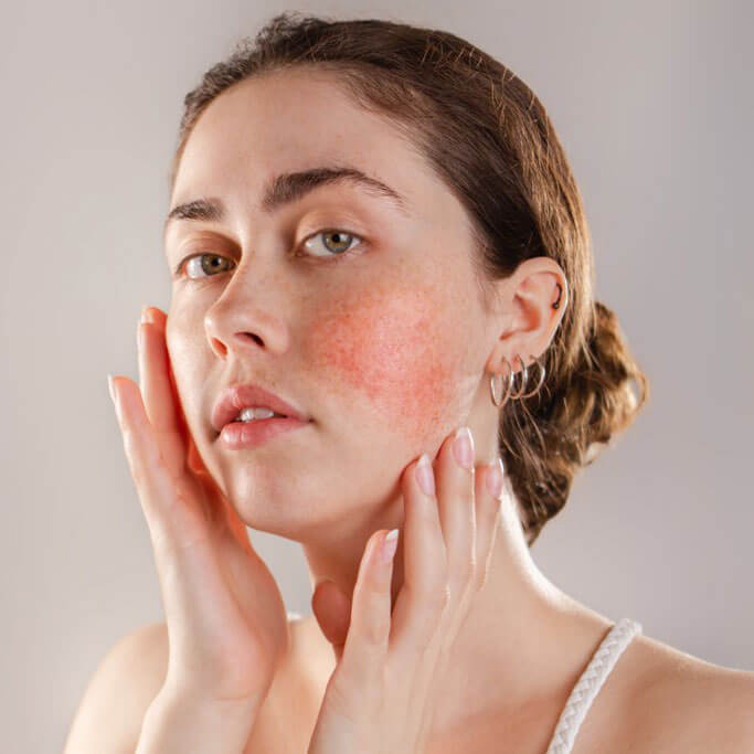 young woman with fair skin and rosacea