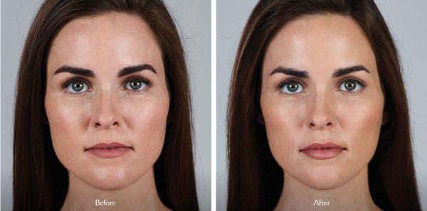 female patient before and after Juvéderm® injections in Fort Worth, TX
