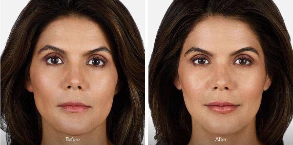 female patient before and after Juvéderm® treatment in Fort Worth, TX