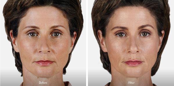female patient before and after Juvéderm® injections in Fort Worth, TX