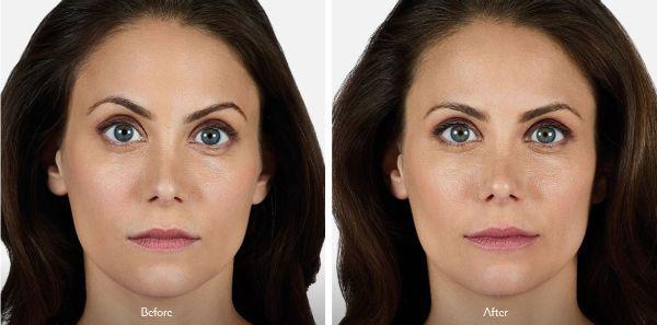 female patient before and after Juvéderm® injections in Fort Worth, TX