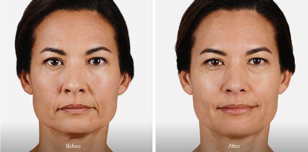 female patient before and after Juvéderm® treatment in Fort Worth, TX