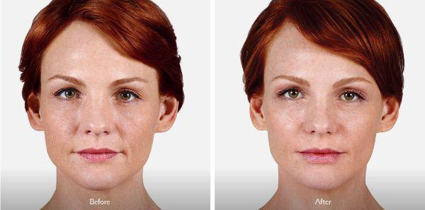 female patient before and after Juvéderm® injections in Fort Worth, TX