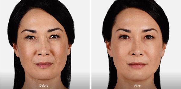 female patient before and after Juvéderm® injections in Fort Worth, TX