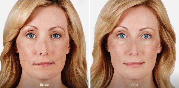female patient before and after Juvéderm® injections in Fort Worth, TX