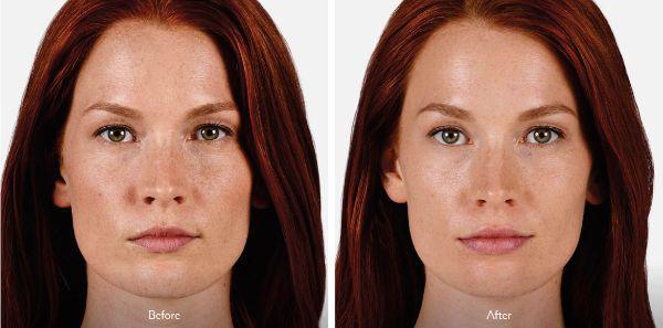 female patient before and after Juvéderm® treatment in Fort Worth, TX