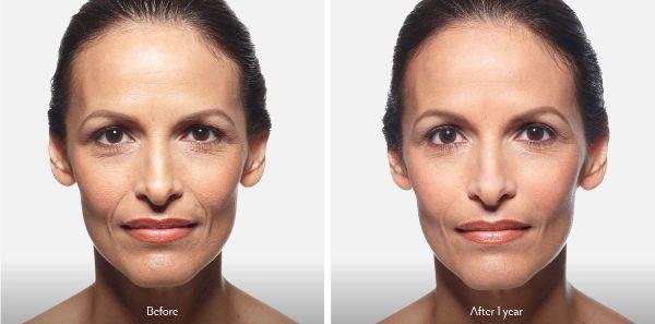 female patient before and after Juvéderm® injections in Fort Worth, TX