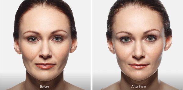 female patient before and after Juvéderm® injections in Fort Worth, TX