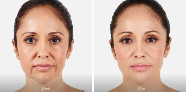 female patient before and after Juvéderm® treatment in Fort Worth, TX