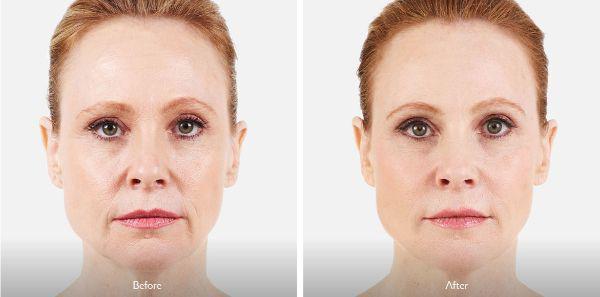 female patient before and after Juvéderm® injections in Fort Worth, TX