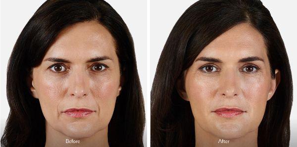 female patient before and after Juvéderm® injections in Fort Worth, TX