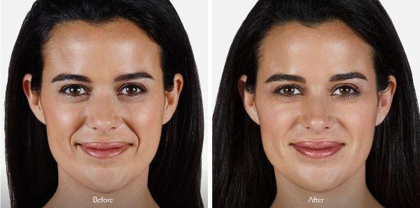 female patient before and after Juvéderm® treatment in Fort Worth, TX