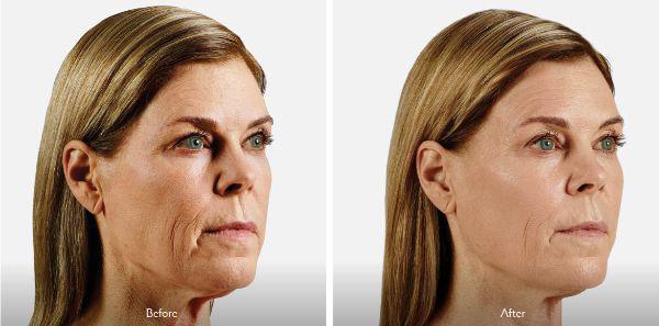 female patient before and after Juvéderm® injections in Fort Worth, TX