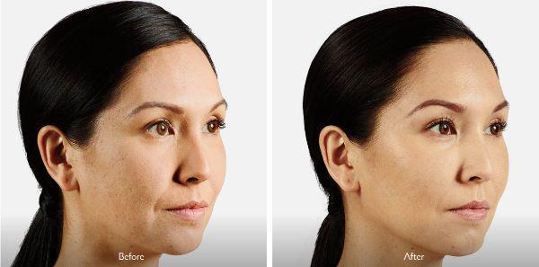 female patient before and after Juvéderm® injections in Fort Worth, TX