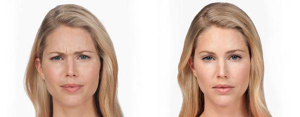 female patient before and after Botox® treatment in Fort Worth, TX
