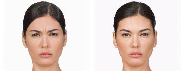 female patient before and after Botox® treatment in Fort Worth, TX