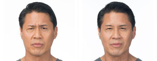 male patient before and after Botox® treatment in Fort Worth, TX