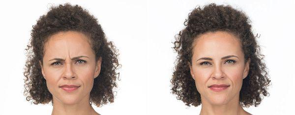 female patient before and after Botox® treatment in Fort Worth, TX