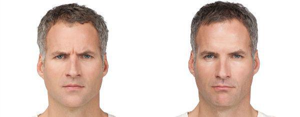 male patient before and after Botox® treatment in Fort Worth, TX