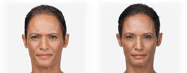 female patient before and after Botox® treatment in Fort Worth, TX