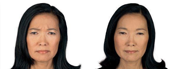 female patient before and after Botox® treatment in Fort Worth, TX
