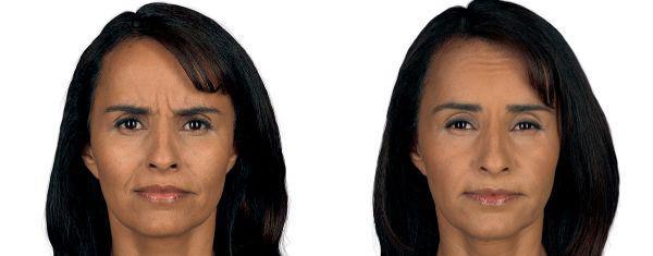 female patient before and after Botox® treatment in Fort Worth, TX