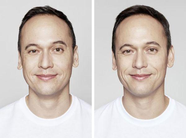 male patient before and after Restylane® treatment in Fort Worth, TX