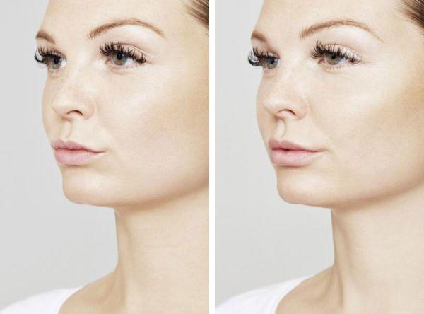 female patient before and after Restylane® treatment in Fort Worth, TX