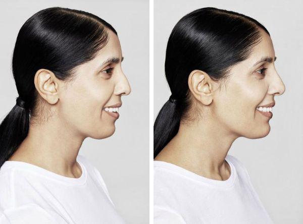 female patient before and after Restylane® treatment in Fort Worth, TX