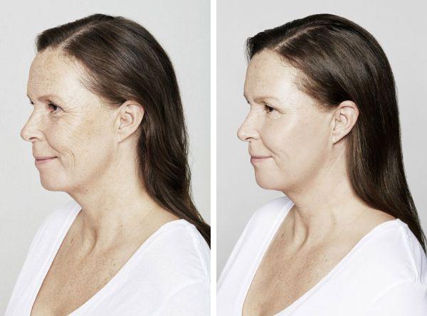 female patient before and after Restylane® treatment in Fort Worth, TX