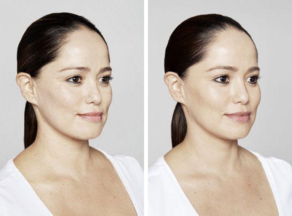 female patient before and after Restylane® treatment in Fort Worth, TX
