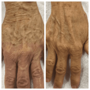 senior patient's hand before and after IPL treatment at Rajan Dermatology