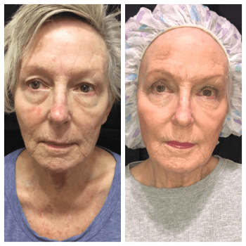 senior patient before and after Sculptra treatment at Rajan Dermatology