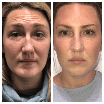 female patient before and after Dysport® treatment in Fort Worth, TX