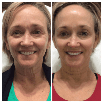 female patient before and after Dysport® treatment in Fort Worth, TX