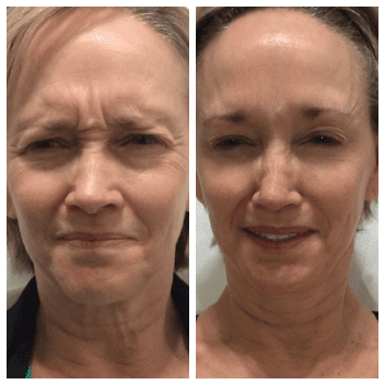 female patient before and after Dysport® treatment in Fort Worth, TX