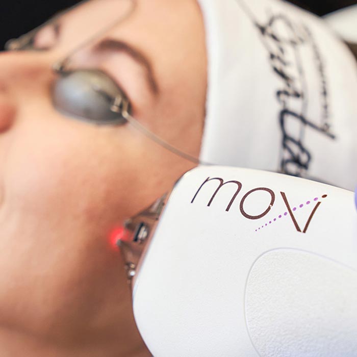 MOXI Laser treatment