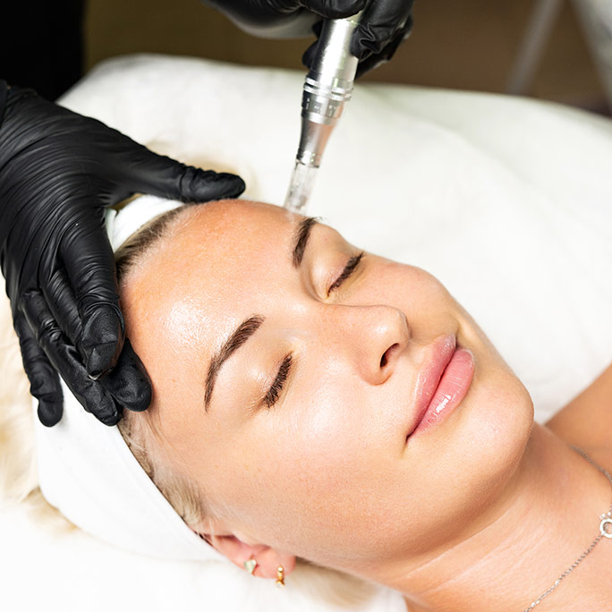 Microneedling treatment